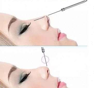 عمليات تجميل الأنف بالخيوط.jpg