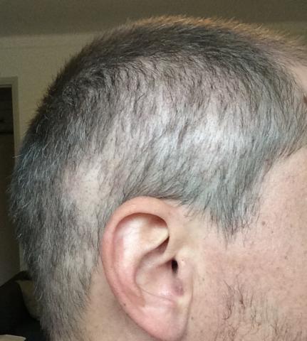 صدمة الشعر بعد زراعة الشعر.jpg