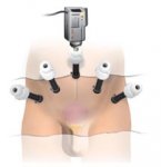 Arabshealth-التدخل الجراحي لعلاج سرطان البروستات.jpg
